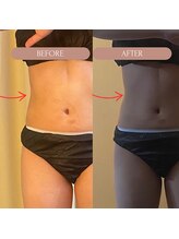 美容痩身ラボ 松山院/施術経過