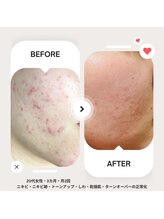 ルミエール(Lumiere)/プラズマの力でニキビ肌改善！