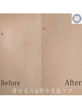 RKY/背中毛穴の黒ずみ☆