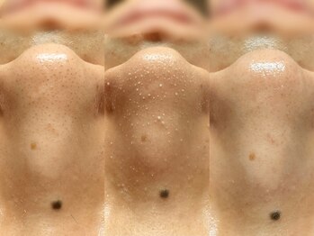 ダリア(Dahlia)の写真/【肌質改善フェイシャル/毛穴洗浄】施術後すぐ実感！毛穴レスな水光肌が叶うケアを。