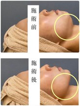 肌音色/■ハイパーフォトケア施術例