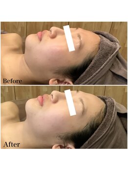 ブローチ 刈谷店(BROOCH)/効果抜群！ハーブピーリング