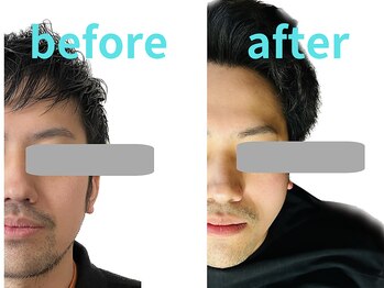 ゼン整体(ZEN)/小顔矯正2回目と13回目の比較