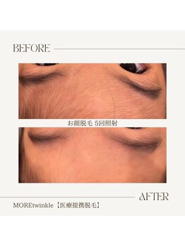 モアトゥインクル 福山宮通り店(MORE twinkle)/人気☆こども脱毛