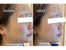 レアビューティー(Le'a beauty)/サーマトリックス×レモンボトル