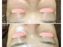 ストーリー(STORY)/ハーブピーリング専門店STORY