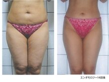 ビューティーリバース センター北店/エンダモロジーインフィニティ