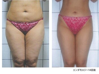 ビューティーリバース センター北店/エンダモロジーインフィニティ