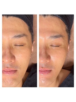 ゾーンビューティーハウス 松戸店(ZONE BEAUTY HOUSE)/第5世代ピーリング 韓国