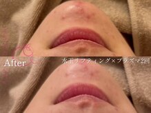 サロンヴェアリー 広尾(salon vary)/繰り返すニキビに