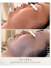 フル(Full)/【50代のフェイスライン変化】
