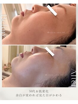 フル(Full)/【50代のフェイスライン変化】