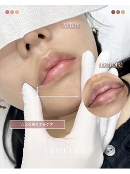 エルビービュティーサロン(LB BEAUTY SALON)/【ルメラ乳輪】実績数関西1★
