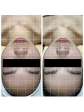 ランプ(LAMP)/～BBL光フェイシャル～