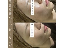 カヨン 新所沢店(KAYON)/ニキビや肌荒れのお悩みにも