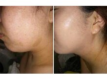 ビソウ(Biso)/ハーブピーリング