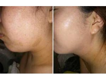 ビソウ(Biso)/ハーブピーリング