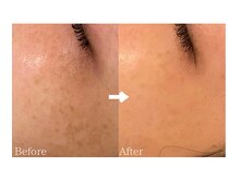 ラシュシュ(La chou chou)/シミケア/くすみ改善/美白