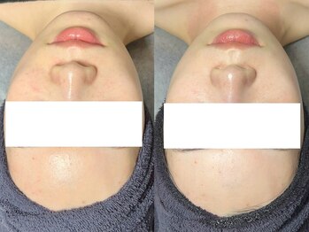 エモーショナル 姫路(Emotional)/ララピール×LDM【毛穴/艶肌】