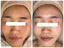 ベル(Bell)/ハーブピーリングbefore/after