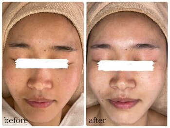 ベル(Bell)/ハーブピーリングbefore/after