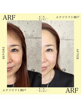 アーフ(ARF)/エクソリフト