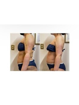 インディバケアプラチナム 横浜店/インディバ施術