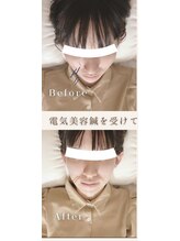 ソメイユ(Sommeil)/美容鍼でお肌のメンテナンスを♪