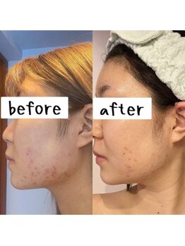 エム(M)/光フェイシャル