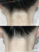 エムズスタイル ネイルバー(M's Style NAIL BAR)/うなじ脱毛　