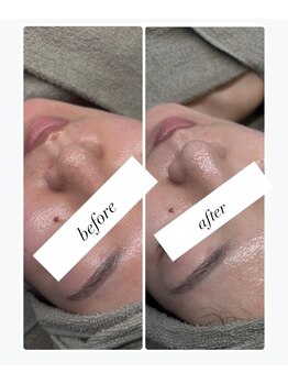 ユズドット(yuzu.)/赤み、ニキビや毛穴にハーブ