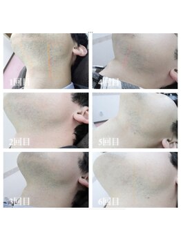 リノア(Linoa)/ヒゲ脱毛経過写真