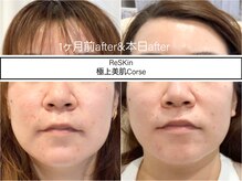 ディアメ(Diame)/1ヶ月前のafterとのお肌の比較!!