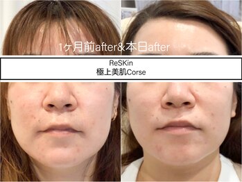 ディアメ(Diame)/1ヶ月前のafterとのお肌の比較!!