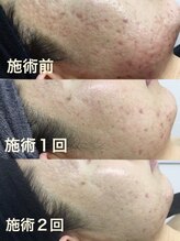 ミュウ(Miu.)/肌質改善できるハーブピーリング