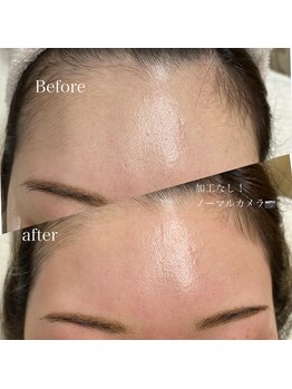 リザボーテ(Liza beate)/フェイスワックス脱毛