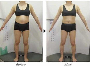 ビューティークリニックコダマ 宮崎本店/【1か月コース】F.N様（45歳）