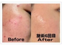 フィオーレ/【学割U24☆ニキビケア+乾燥＋】