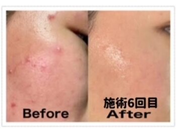 フィオーレ/【学割U24☆ニキビケア+乾燥+】