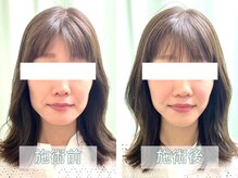 三軒茶屋おの整骨院 はり灸マッサージ院/【美容鍼ビフォーアフター】
