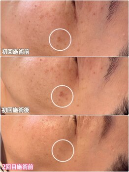 アマラ(Amarra)/目立ったシミもこんなに綺麗に