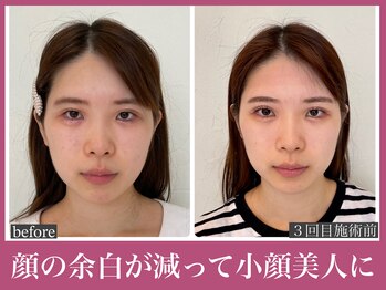 アクアビー(AQUA-B)/歪み・面長改善例【金剛/小顔】