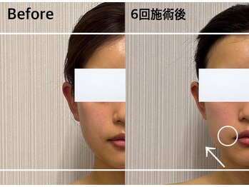 ベール(BEHL)/コルギのBefore After