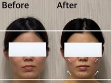 ベール(BEHL)/コルギのBefore After