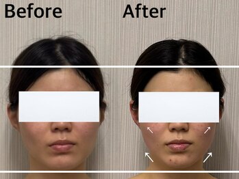 ベール(BEHL)/コルギのBefore After