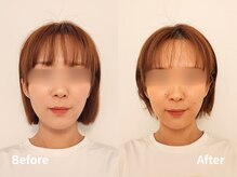 ユウキシキ(YUKISIKI)/YUKISIKI小顔矯正&美容鍼