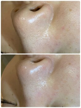 シャイニング(shining)/☆毛穴ケア