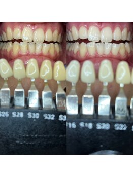 トウキョウスワーズ 池袋店(TOKYO SWRS)/#ホワイトニング #池袋 #渋谷
