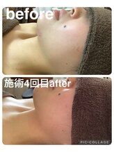 ギンザアール(GINZA R.)/すっきり小顔に◎