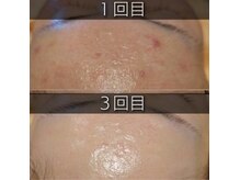 クロッシュ(Cloche)/ニキビケア